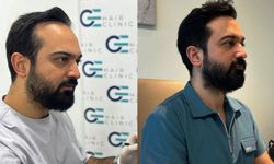 Ataşehir Saç Ekimi - Dr. Gökeşme ile Doğal ve Kalıcı Sonuçlar