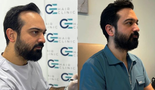 Ataşehir Saç Ekimi - Dr. Gökeşme ile Doğal ve Kalıcı Sonuçlar